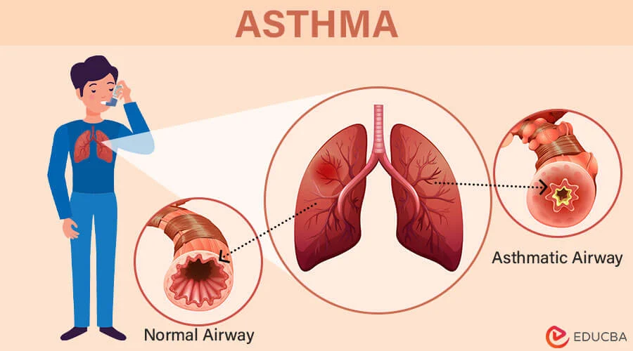 Asthma Air Way - The Updated World