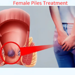 piles treatment - The Updated World